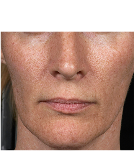 Her face after one treatment with Fraxel fractional skin resurfacing laser